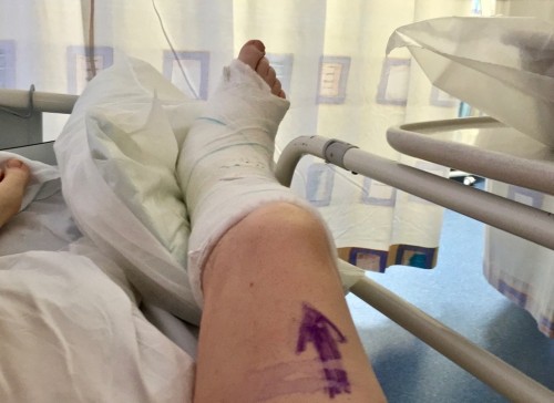 Mashed Ankle 1.12.12015.jpeg (154.33 KiB) Viewed 1738 times Mashed ankle and NHS arrow..