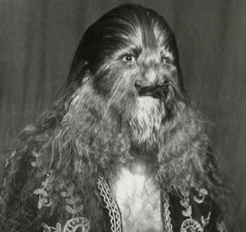 A case of extreme hirsutism.